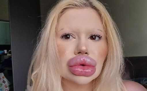 Девушка с самыми огромными в мире губами принялась за нос